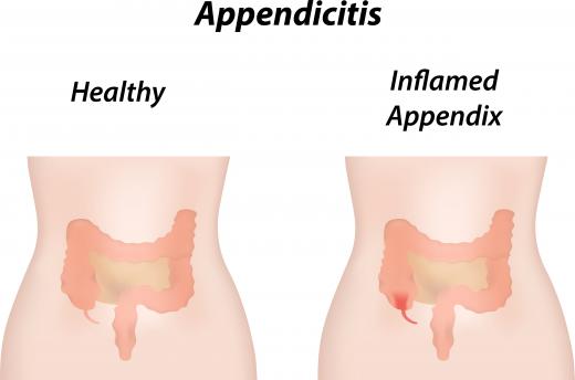 Anaerobic bacteria is linked to serious illnesses like appendicitis.
