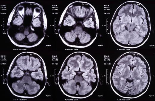 Brain scans can be used to observe brain activity in various regions, such as the cortex.