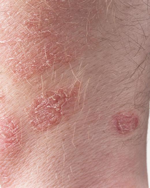 Zinc pyrithione may be used to treat psoriasis.