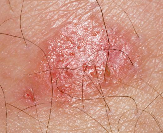 Ringworm is a fungal infection that may be treated with zinc pyrithione.