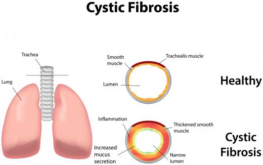 A person whose cystic fibrosis transmembrane regulator genes are both mutated will have cystic fibrosis.