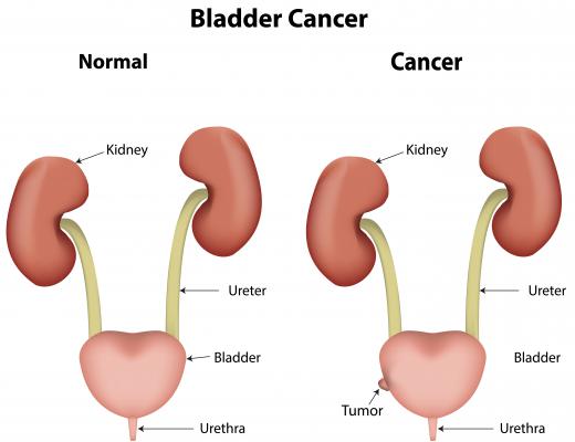 Arsenic exposure may increase an individual's risk of developing bladder cancer.