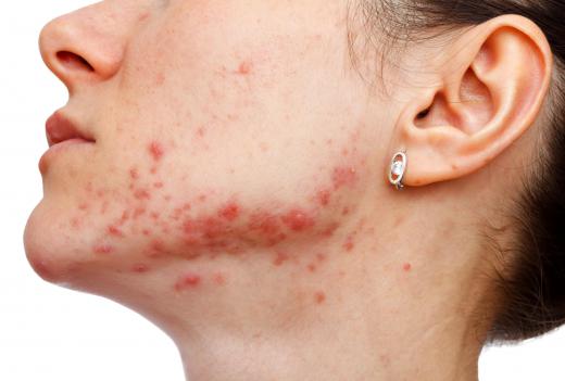 Acne can be cause by Staphylococcus aureus, a type of anaerobic bacteria.