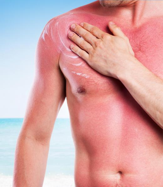 A common danger of UV waves is sunburns.