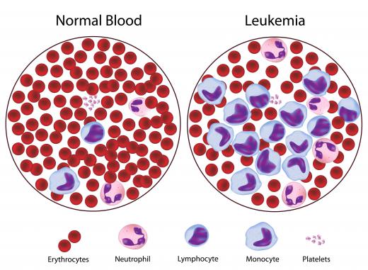 Samples of blood from a healthy person and one with leukemia. Low MPV measurements may be associated with serious illnesses such as leukemia.
