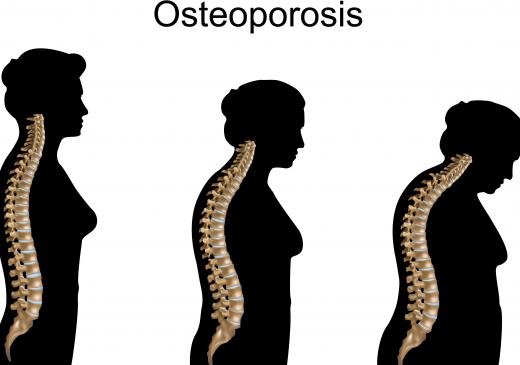 In patients with osteoporosis, the osteoclasts resorb more bone tissue than their osteoblasts are replacing.