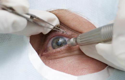 Hypromellose may be used during eye surgery to keep the eye lubricated.