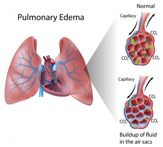 An individual's colloid osmotic pressure may be measured to diagnose pulmonary edema.