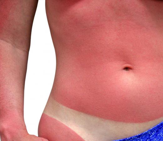 Sunblock can be used to prevent severe sunburn.